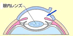 ちあき眼科 一宮 眼の病気について